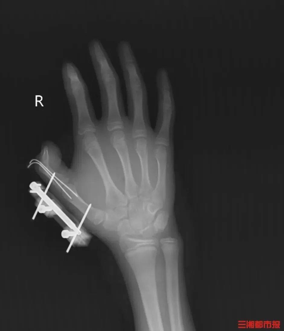 突然爆炸！这个常见保鲜品暗藏危险！